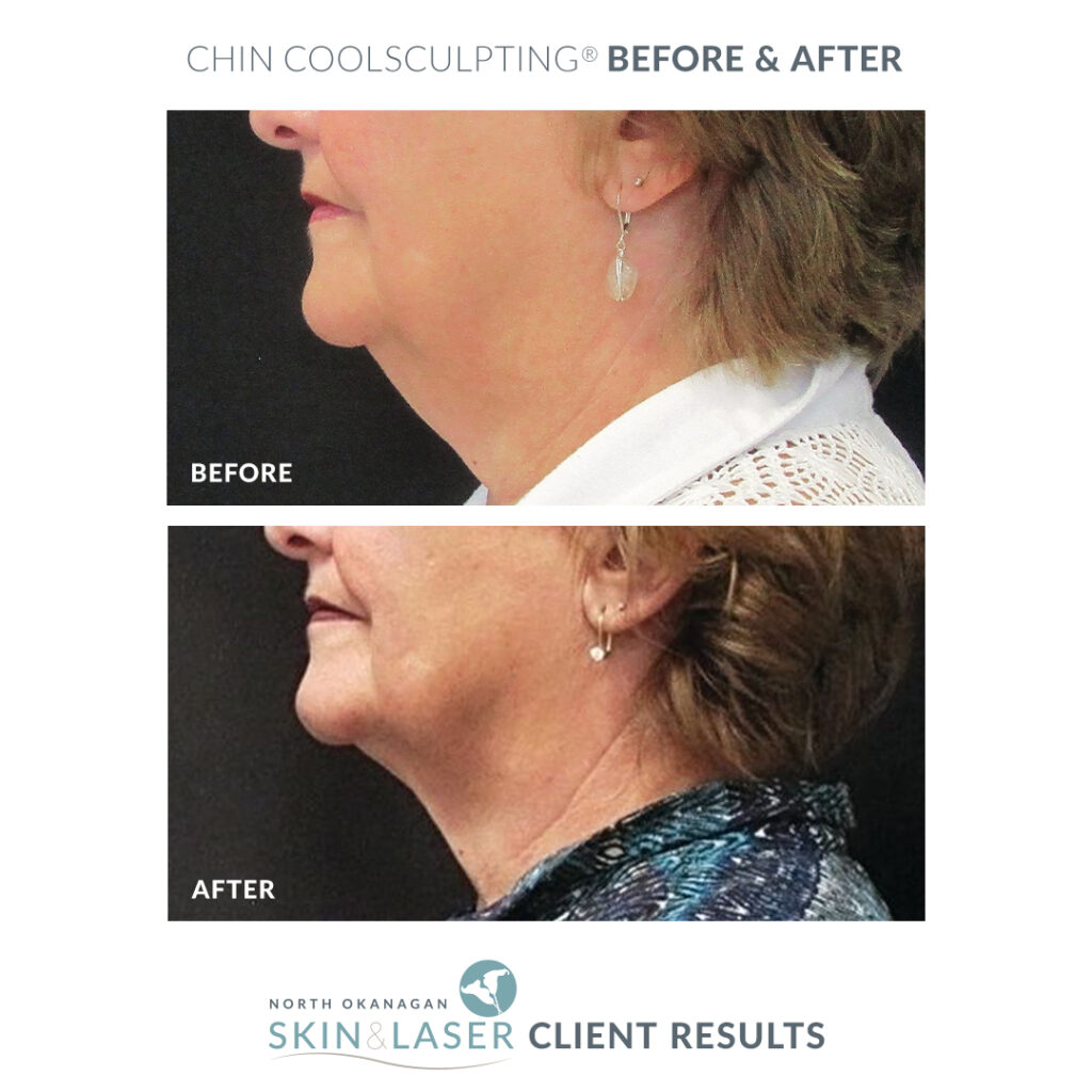 CoolSculpting CoolSculpting Costs North Okanagan Skin Laser