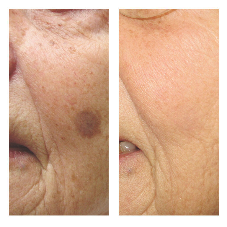 nosl IPL Photorejuvenation face 5