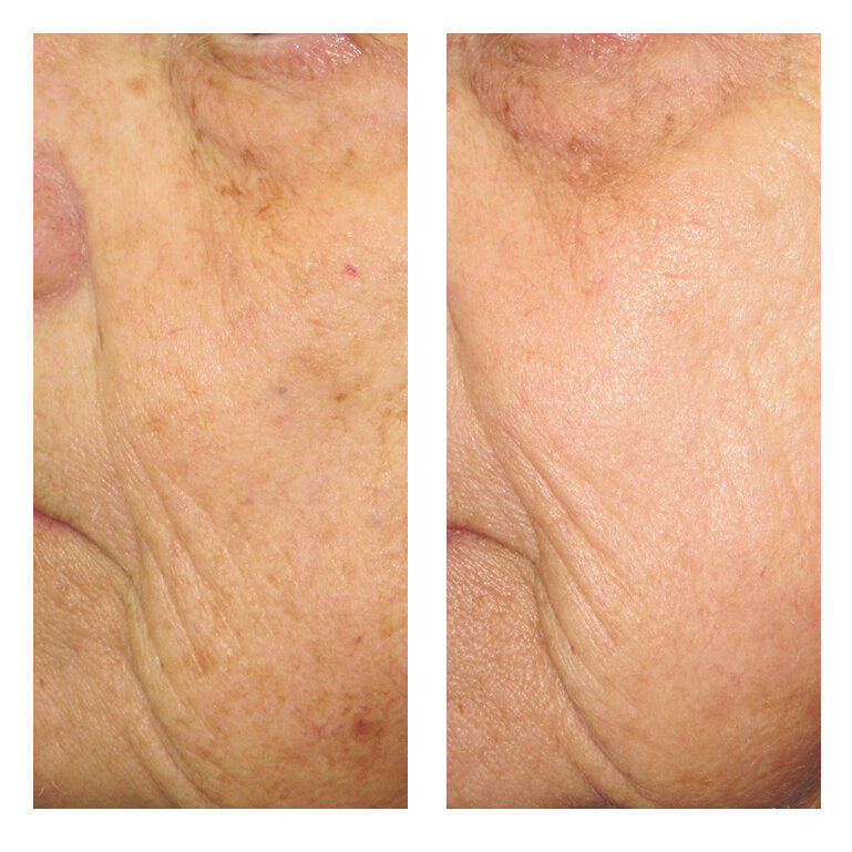 nosl IPL Photorejuvenation face 4
