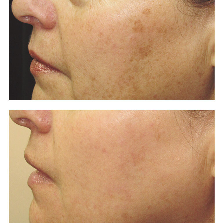 nosl IPL Photorejuvenation face 3