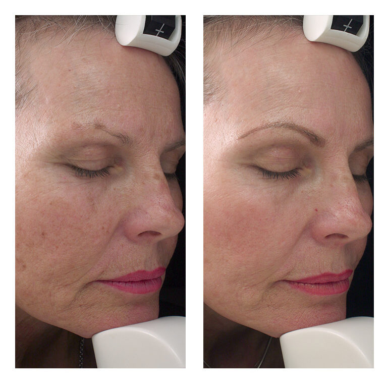 nosl IPL Photorejuvenation face 2