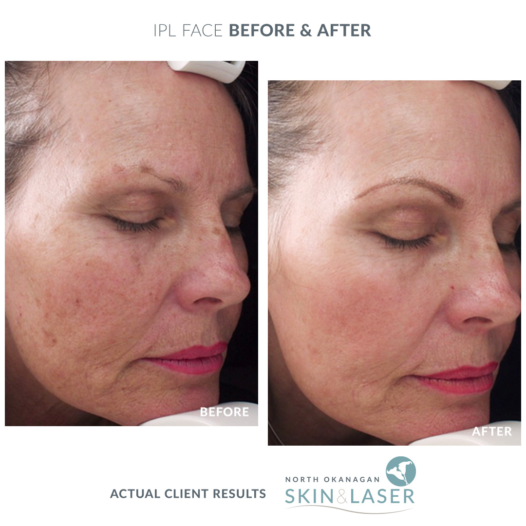 IPL Photorejuvenation – North Okanagan Skin & Laser