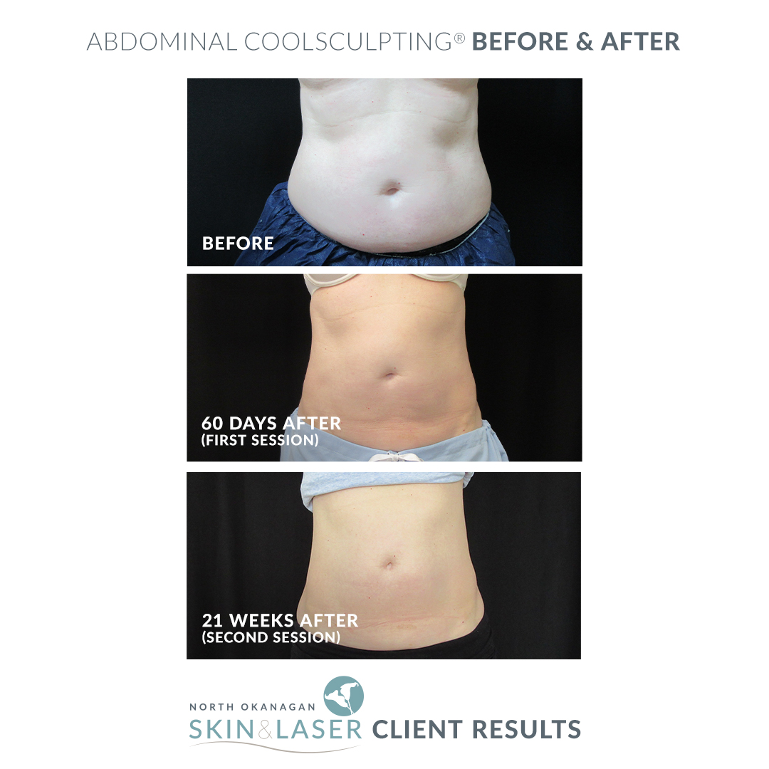Coolsculpting, Fat Reduction & Cell Removal